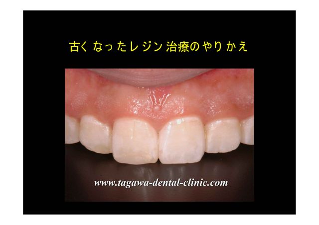 保険レジンによる再治療後の前歯写真